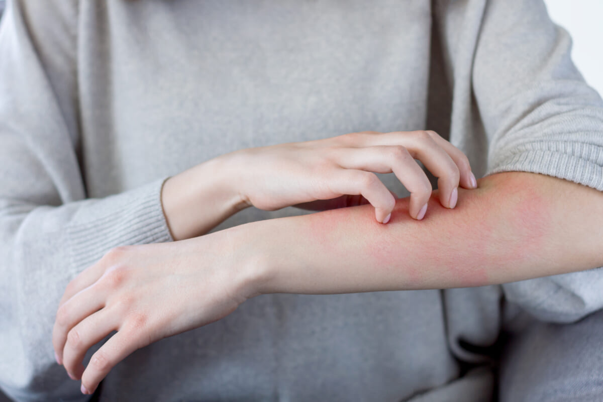 Person rubbing a reddened irritated patch on their forearm a sunburn like rash is visible on the skin